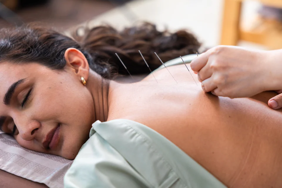 acupuncture therapy